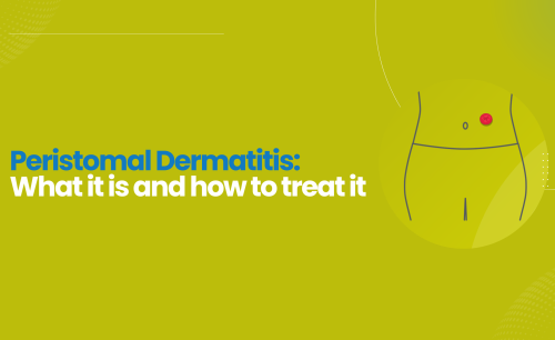 Peristomal dermatitis: What it is and how to treat it